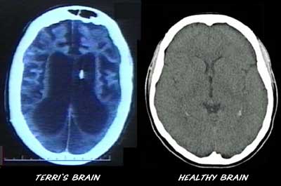 CT scan of Terri Schiavo's brain.